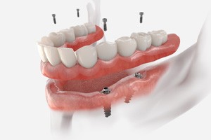 animated model of implant denture 