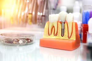 Model of dental implants in Worcester on countertop