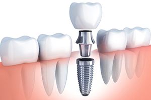 Dental implant in Worcester