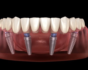 A diagram of a mouth with four strategically placed dental implants