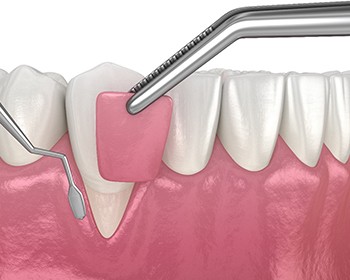 A digital image of a piece of gum tissue being placed over the exposed root area of a tooth