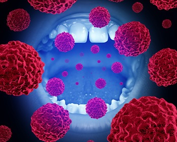 Illustration of mouth and oral cancer cells