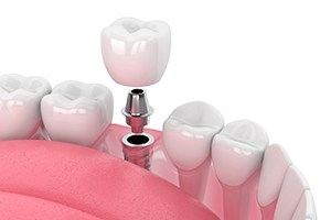 Benefits of dental implants in Worcester
