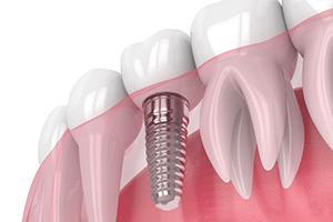 Dental implants in Worcester