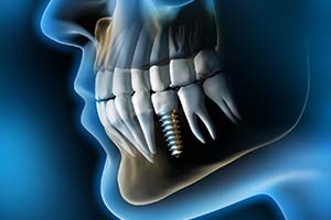X-ray diagram of dental implants in Worcester