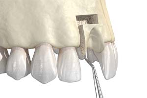 Bone grafting in Worcester