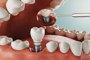 Diagram showing how dental implants in Worcester work