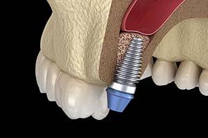 Diagram of a sinus lift in Worcester for dental implant