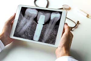 Dentist holding X-ray of dental implant in Worcester
