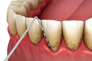 Dental probe being used to assess gum recession
