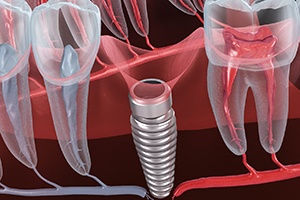 Failed dental implant in Worcester
