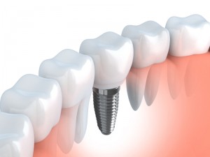 drawing of a dental implant in place