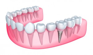 Worcester dental implants from Handsman & Haddad Periodontics