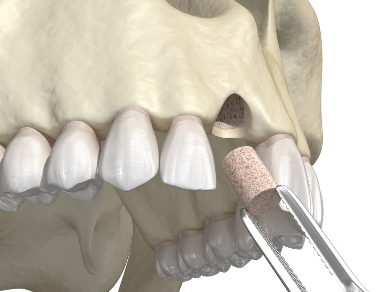 a digital image of a bone graft occurring at the front of the arch