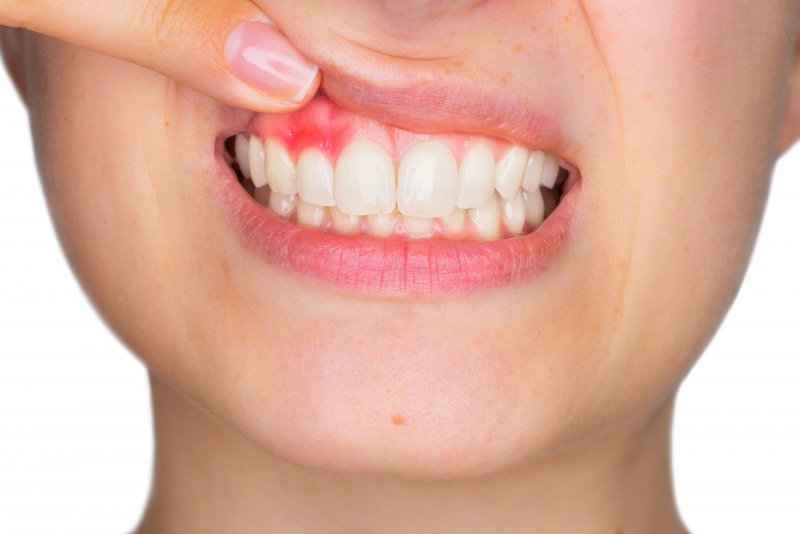 an up-close look at a person pulling their top lip up to expose their red, swollen gums