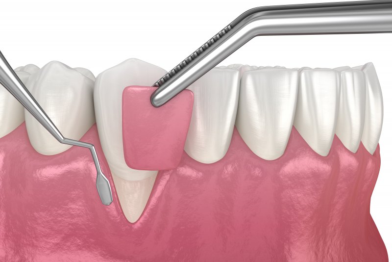 a digital image of a gum graft being perform on the lower arch of the mouth