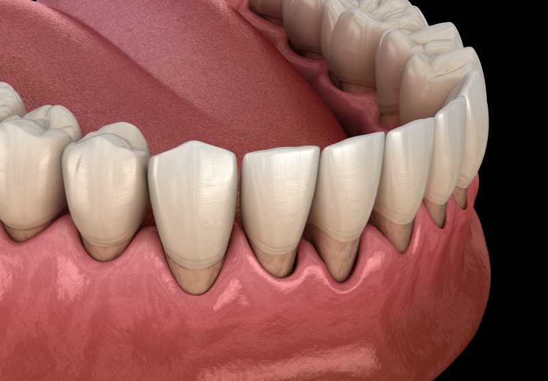 a digital image of gums receding as a result of periodontal disease 