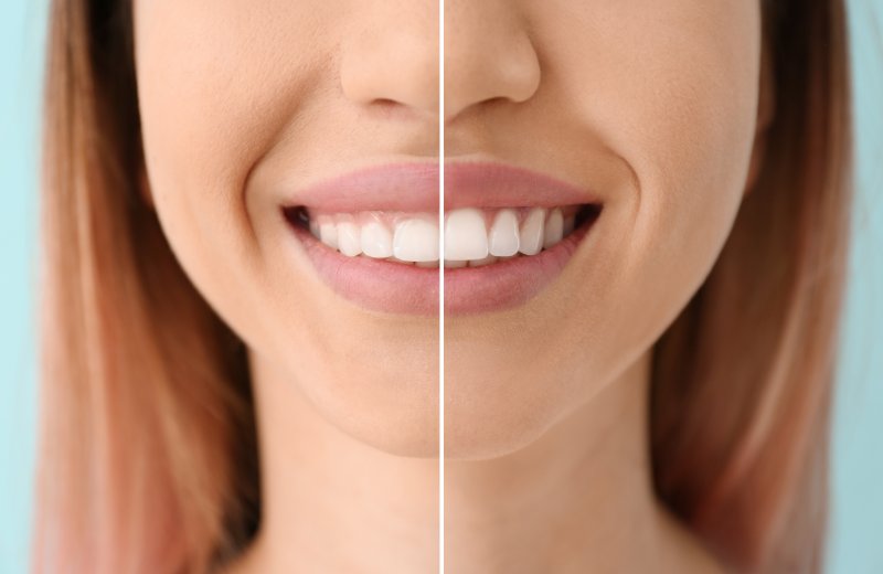 a side-by-side image of a woman’s smile before and after gum recontouring