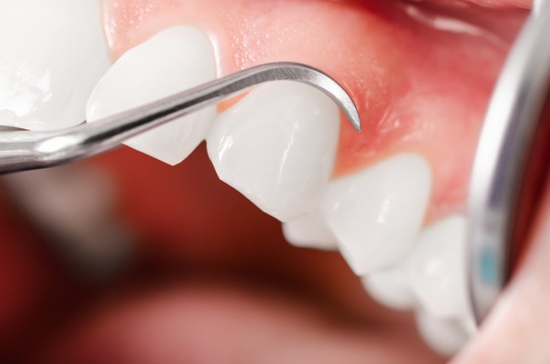 up-close view of a person’s gums in Worcester