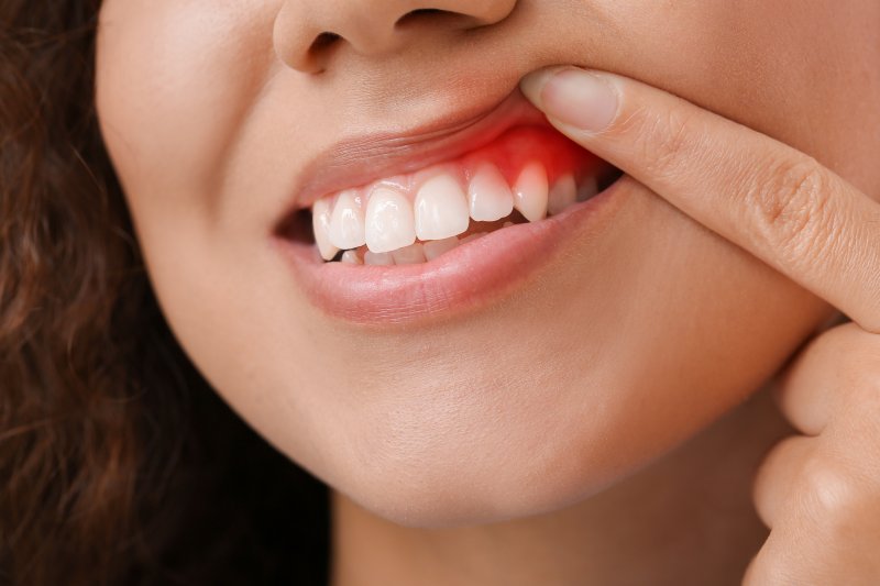 a person exposing their red, inflamed gums 