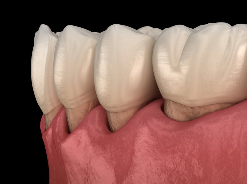 receding gums 