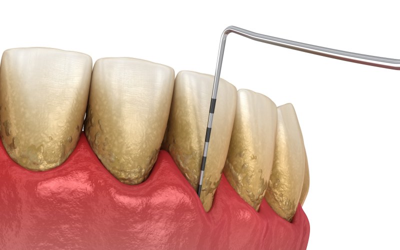 severe gum disease 