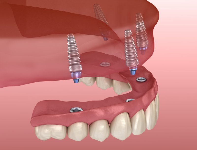 All-On-4 implants