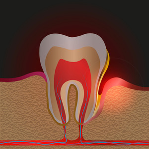 Illustration of a periodontal pocket due to gum disease