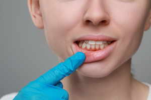 Gloved finger pulling patient’s lips to show inflamed gums