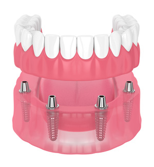 Illustration of implant dentures for the lower jaw