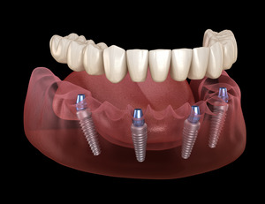 Illustration of All-on-4 dental implants and denture