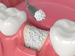Illustration of bone grafting performed in lower jaw