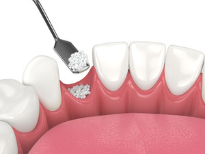 Illustration of bone grafting being performed in the lower jaw