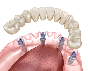 Illustration of All-on-4 for lower arch