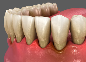 Illustration of gum recession exposing the roots of your teeth