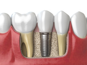 Illustration of dental implant in jaw among natural teeth