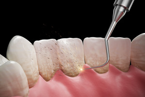 Illustration of scaling and root planing performed on back of teeth
